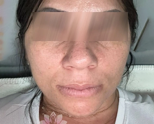 Resultado de tratamento facial antes do tratamento