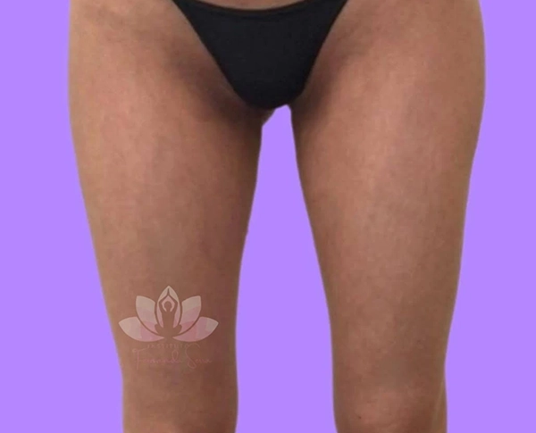 Resultado de tratamento corporal antes do tratamento